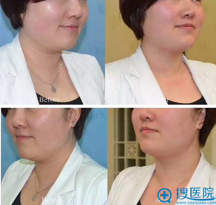 术前术后侧面对比照片 术前术后侧面对比照片