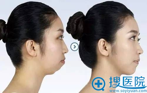 南京维多利亚整形告诉你 姑娘,你是嘴凸么 不,你是下巴短