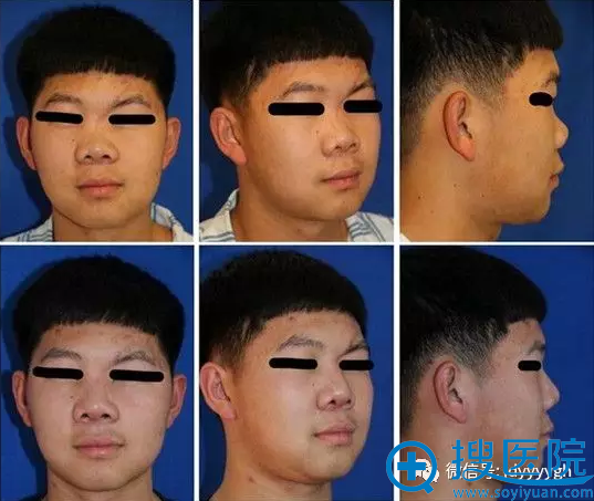 吉大一院整形外科邵英儿童肋软骨移植矫正重度鞍鼻畸形案例