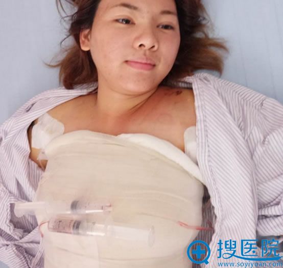 广州晨曦陈柯整形如何 曼托中突型270假体隆胸恢复效果来揭密