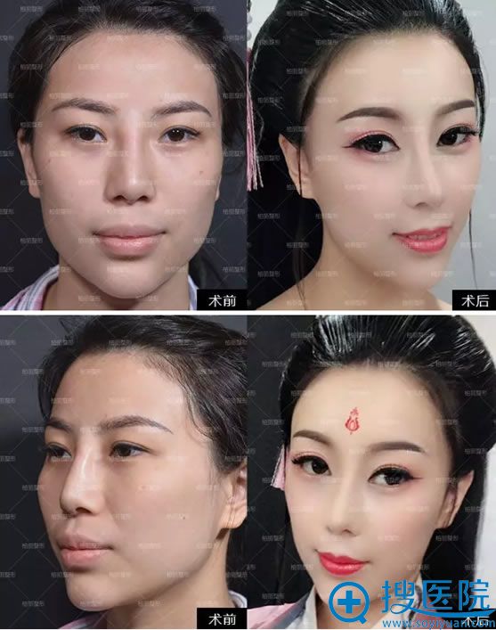 骨粉隆鼻能取出来吗分享我这次在北京柏丽取出鼻子骨粉的经历