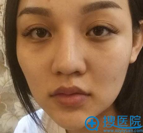 姐妹们隆鼻失败不要气馁,我在北京玲珑梵宫王光辉这修复成功了