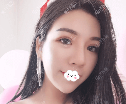段世玉上睑下垂矫正术后效果 段世玉上睑下垂矫正术后效果