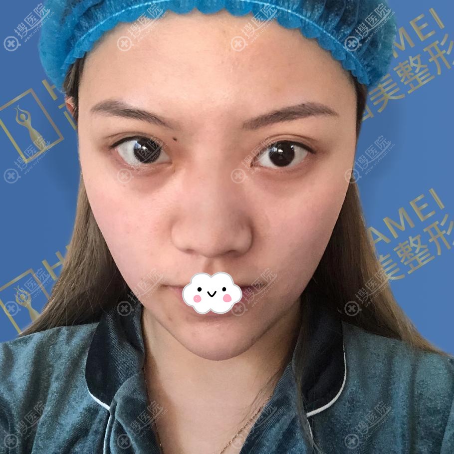 1w价格找张勇做硅胶假体隆鼻综合