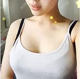 惠州瑞悦美李依力假体隆胸案例