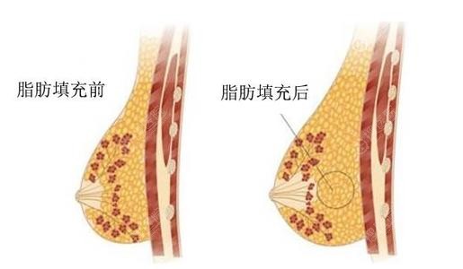 复合式隆胸就是在假体的基础上配合自体脂肪手感更真实自然