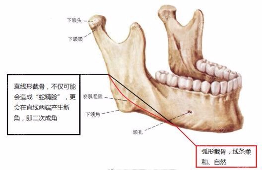 下颌角手术切除示意图