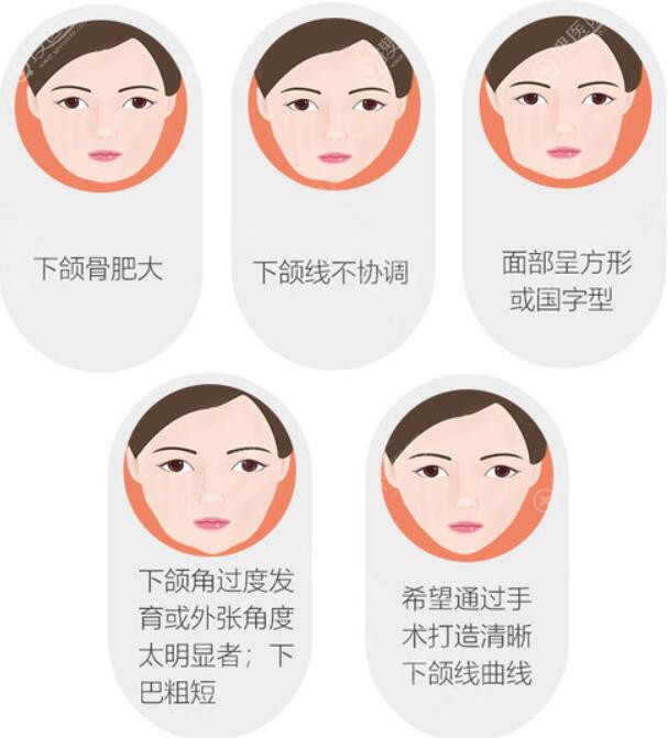 不削骨如何改变下颌角咬肌大和骨骼大的改善方式是不一样的