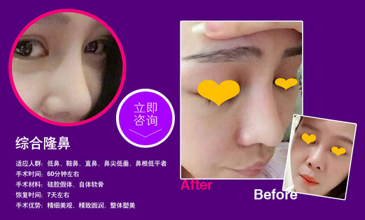 做手术隆鼻_隆鼻手术隆鼻_做隆鼻手术