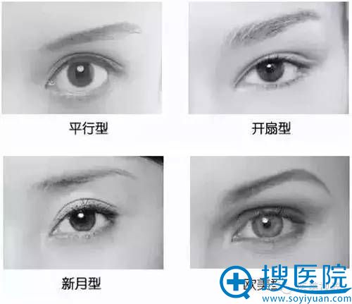 双眼皮四种类型:平行型、开扇型、新月型和欧美型