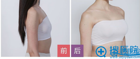  深圳鹏程整形医院胸部整形案例