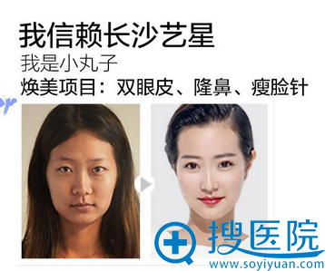 长沙艺星顾客双眼皮、隆鼻、手术案例图片：