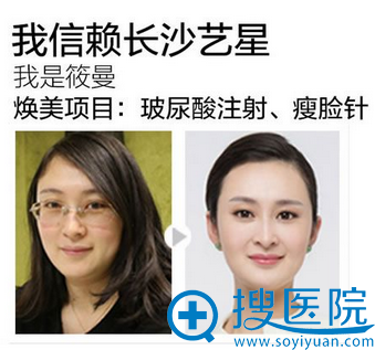 长沙艺星顾客玻尿酸注射、手术案例图片：