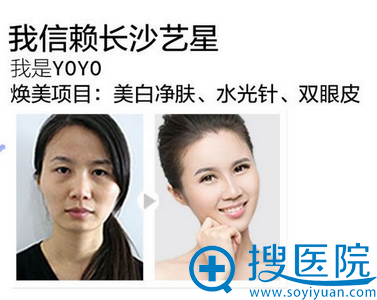 长沙艺星顾客美白净肤、、双眼皮手术案例图片：