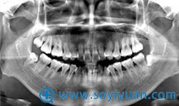 3D CT+ǻȫƬʹӰȫ