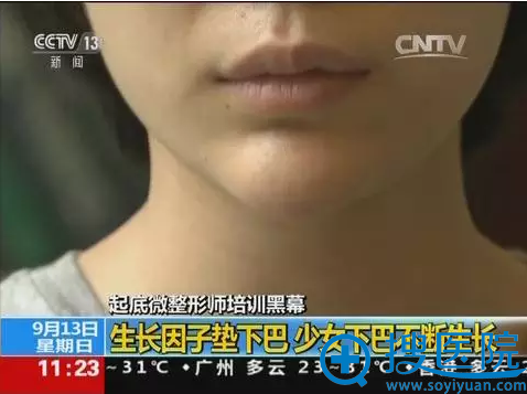 生长因子垫下巴 少女下巴不断生长