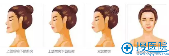 上颌后缩下颌前突、上颌前突下颌后缩、双颌前突(俗称“龅牙”)、面部不对称畸形示例 上颌后缩下颌前突、上颌前突下颌后缩、双颌前突(俗称“龅牙”)、面部不对称畸形示例
