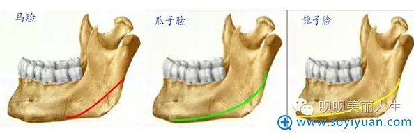 骨切除的范围与形成后期脸型的关系