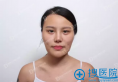 韩国女神轮廓手术真人案例 吊炸天的换头记录