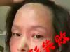 西安女子在脸部1次性注射100针美容针剂 美容不成反毁容