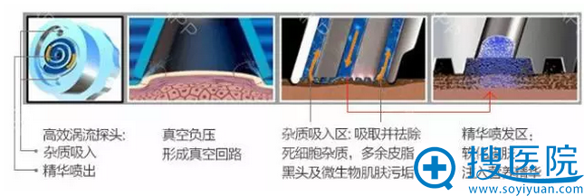 韩国小气泡工作原理
