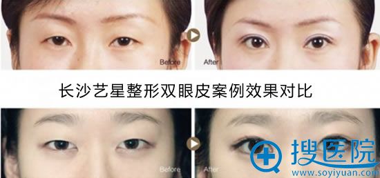 长沙艺星整形双眼皮案例图