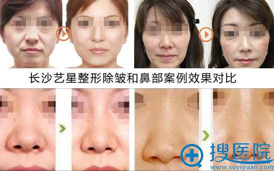 长沙艺星鼻部整形和除皱案例