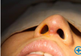 上海美莱征集6名鼻整形失败者免费修复