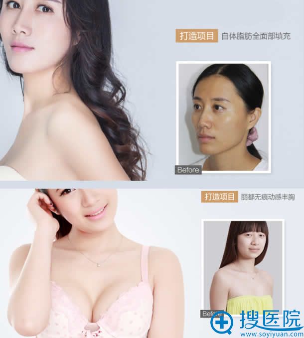 无锡丽都自体脂肪填充及隆胸案例