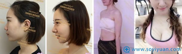 河南整形美容医院隆鼻和丰胸案例