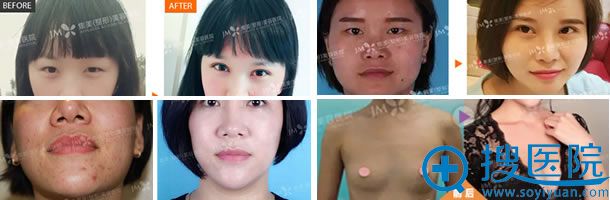 郑州集美整形案例效果图