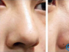 沧州枫华林敬华解析 玻尿酸隆鼻和假体隆鼻的区别