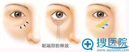 眶隔释放法祛眼袋手术过程