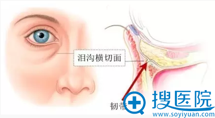 泪沟形成原因