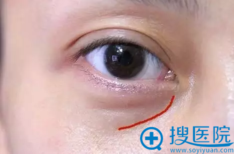 红线处就是泪沟