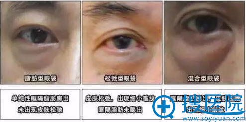 不同类型眼袋出现的原因