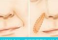 玻尿酸和自体脂肪填充哪种方法祛除法令纹、鼻唇沟更有效？