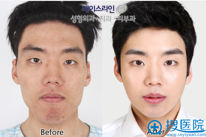 韩国FACE-LINE整形外科医院smart双颚手术前后对比照