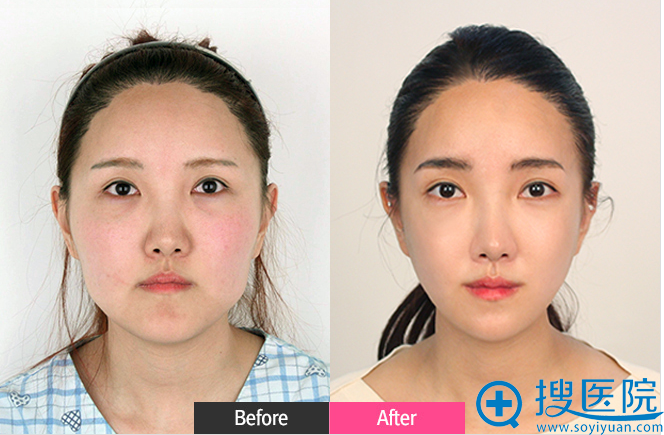韩国FACE-LINE整形外科医院下颌角+颧骨整形案例