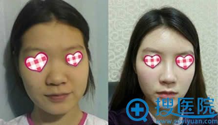 韩国iFace做的塌鼻子隆鼻前后对比照片
