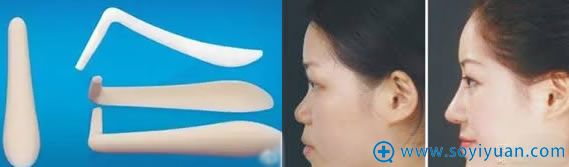 硅胶隆鼻材料及效果对比图