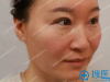 看我在天津464整形医院美容科找许进前做完热拉提效果怎么样
