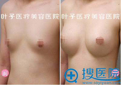 武汉叶子无痕美胸术后对比照
