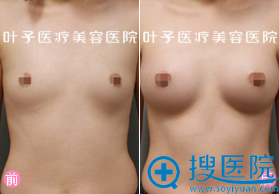 武汉叶子自体脂肪丰胸案例
