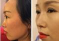 分享我在郑州美丽时光找郭晓光院长做线雕隆鼻恢复过程图片