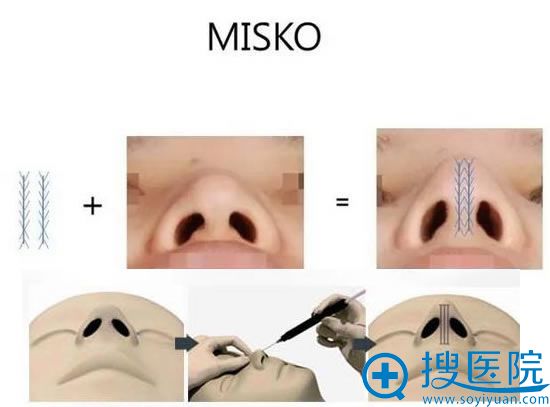 什么是MISKO线雕隆鼻