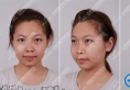 【亲身经历】在天津美莱整形医院注射玻尿酸隆下颌+隆鼻效果图