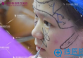 【案例】刚在深圳雅涵医疗整形找高山隆鼻子3个月 看效果怎么样