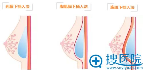 日本假体隆胸的手术方法示意图