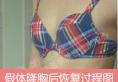 分享在北京煤炭总医院找赵作钧做假体隆胸后246天恢复过程图